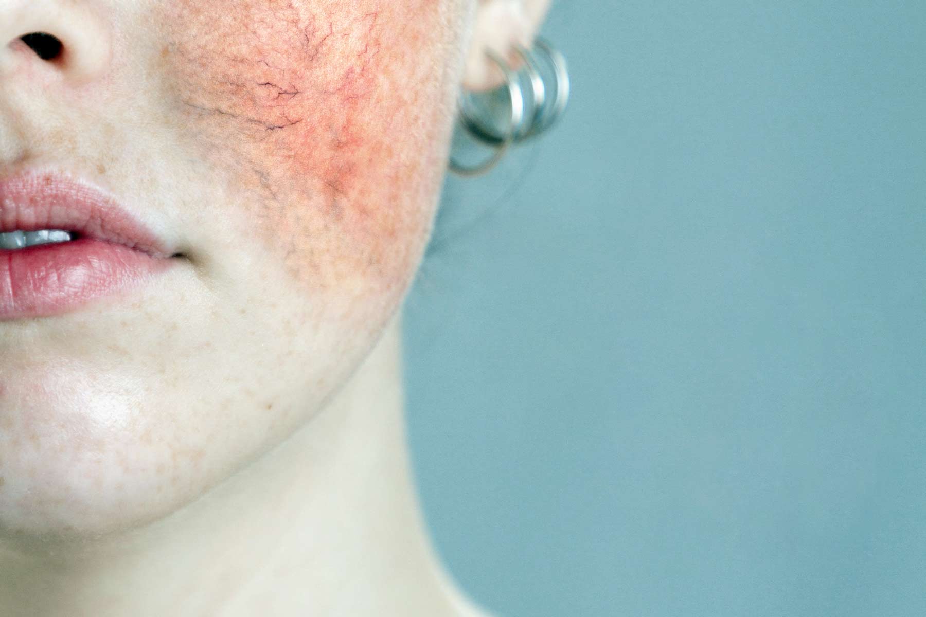 rosácea