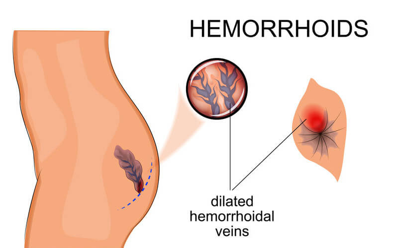 Todo lo que debes saber sobre las Hemorroides