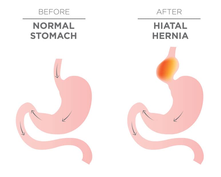 ¿Qué es la hernia de hiato?