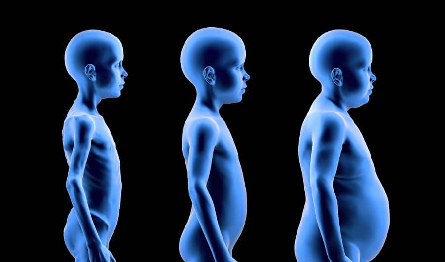 ¿Qué es la Malnutrición?